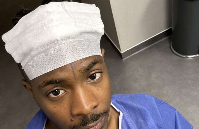 Transplantation of Jonn's Hair: A Young Man's Story